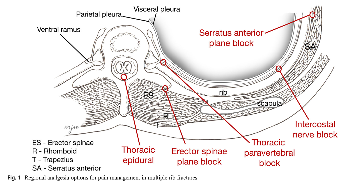 Regional Analgesia Options